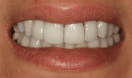 Complications In Aesthetic Dentistry