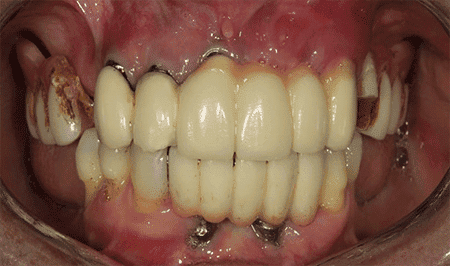 Complications In Implant Dentistry