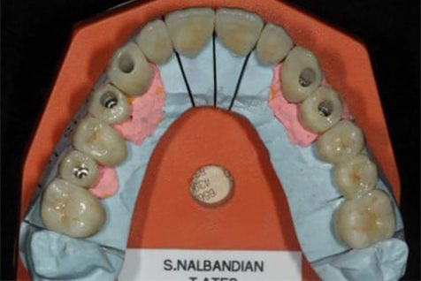 Implant Prosthodontics-Surgical Planning